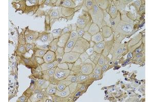 Immunohistochemistry of paraffin-embedded human breast cancer using GGT1 antibody (ABIN3022526, ABIN3022527, ABIN3022528 and ABIN6218881) at dilution of 1:100 (40x lens).