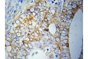 Immunohistochemistry of paraffin-embedded Prostate cancer using HSPA5 antibody. (GRP78 anticorps  (AA 550-650))