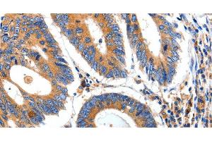 Immunohistochemistry of paraffin-embedded Human colon cancer tissue using IGFBP7 Polyclonal Antibody at dilution 1:50 (IGFBP7 anticorps)