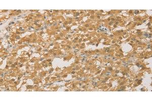 Immunohistochemistry of paraffin-embedded Human thyroid cancer using PGK2 Polyclonal Antibody at dilution of 1:50 (PGK2 anticorps)