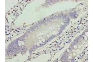 Immunohistochemistry of paraffin-embedded human colon cancer using ABIN7175336 at dilution of 1:100