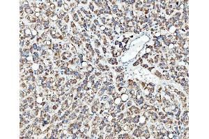 IHC analysis of TRK fused gene/TFG using anti-TRK fused gene/TFG antibody (ABIN7599839). (TFG anticorps  (AA 121-400))
