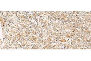 Immunohistochemistry of paraffin-embedded Human liver cancer tissue using GPR22 Polyclonal Antibody at dilution of 1:50(x200)