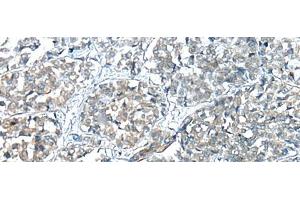 Immunohistochemistry of paraffin-embedded Human esophagus cancer tissue using COMMD6 Polyclonal Antibody at dilution of 1:45(x200) (COMMD6 anticorps)