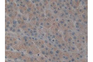 DAB staining on IHC-P; Samples: Human Liver cancer Tissue