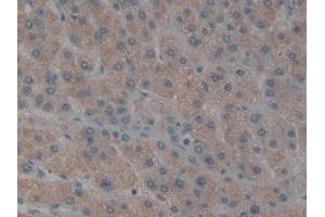 DAB staining on IHC-P; Samples: Human Liver cancer Tissue (TAB1 anticorps  (AA 189-439))