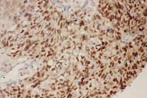 Anti-P53 Picoband antibody,  IHC(P): Human Lung Cancer Tissue