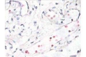 Immunostaining of human breast cancer tissue showing p38 when phosphorylated at Thr180/Tyr182 in red. (MAPK14 anticorps  (pThr180, pTyr182))