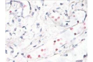 Immunostaining of human breast cancer tissue showing p38 when phosphorylated at Thr180/Tyr182 in red. (MAPK14 anticorps  (pThr180, pTyr182))