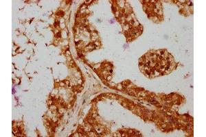 IHC image of ABIN7166095 diluted at 1:364 and staining in paraffin-embedded human prostate cancer performed on a Leica BondTM system.