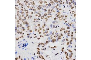 Immunohistochemistry of paraffin-embedded human thyroid cancer tissue using H4K20me2 antibody at dilution of 1:200 (x400 lens).
