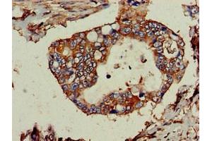 Immunohistochemistry of paraffin-embedded human pancreatic cancer using ABIN7173913 at dilution of 1:100