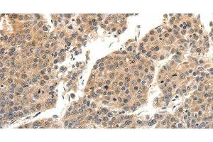 Immunohistochemistry of paraffin-embedded Human liver cancer tissue using SLC27A1 Polyclonal Antibody at dilution 1:40 (SLC27A1 anticorps)