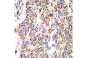 Immunohistochemistry of paraffin-embedded human esophageal cancer using ATP5A1 antibody at dilution of 1:100 (x40 lens). (ATP5A1 anticorps)