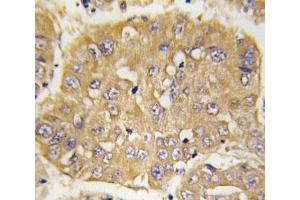 IHC analysis of FFPE human hepatocarcinoma tissue stained with IGFBP3 antibody