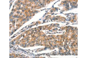 Immunohistochemistry of Human breast cancer using STK17A  Polyclonal Antibody at dilution of 1:25 (STK17A anticorps)