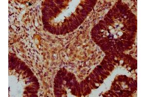 IHC image of ABIN7172627 diluted at 1:400 and staining in paraffin-embedded human ovarian cancer performed on a Leica BondTM system.