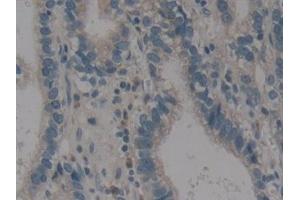 Detection of ALOX12 in Human Stomach cancer Tissue using Polyclonal Antibody to Arachidonate-12-Lipoxygenase (ALOX12)