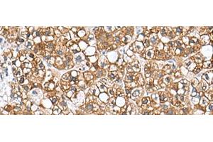 Immunohistochemistry of paraffin-embedded Human liver cancer tissue using PHLDA3 Polyclonal Antibody at dilution of 1:110(x200)