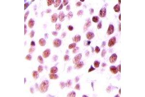 Immunohistochemical analysis of MDM2 staining in human prostate cancer formalin fixed paraffin embedded tissue section.