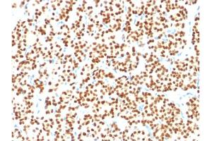 Formalin-fixed, paraffin-embedded human thyroid carcinoma stained with PAX8 Mouse Monoclonal Antibody (PAX8/1491).