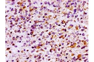 IHC image of ABIN7156768 diluted at 1:100 and staining in paraffin-embedded human glioma performed on a Leica BondTM system.
