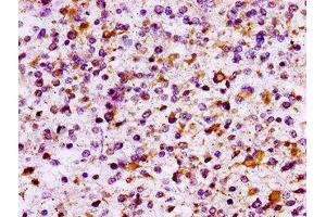 IHC image of ABIN7156768 diluted at 1:100 and staining in paraffin-embedded human glioma performed on a Leica BondTM system. (IL1R2 anticorps  (AA 79-219))