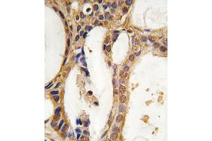 Formalin-fixed and paraffin-embedded human prostata carcinoma tissue reacted with PIM1 antibody, which was peroxidase-conjugated to the secondary antibody, followed by DAB staining. (PIM1 anticorps)