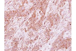 IHC-P Image Homer3 antibody detects Homer3 protein at cytoplasm on human Papillary adenocarcinoma by immunohistochemical analysis.