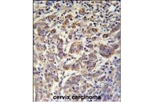 ANKRD57 Antibody (C-term) (ABIN651987 and ABIN2840483) immunohistochemistry analysis in formalin fixed and paraffin embedded human cervix carcinoma followed by peroxidase conjugation of the secondary antibody and DAB staining. (ANKRD57 anticorps  (C-Term))