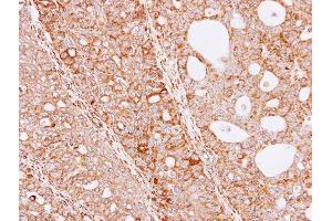 IHC-P Image Immunohistochemical analysis of paraffin-embedded Serous OVCA xenograft, using THUMPD3, antibody at 1:100 dilution.