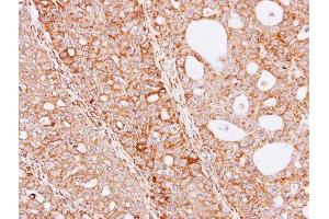 IHC-P Image Immunohistochemical analysis of paraffin-embedded Serous OVCA xenograft, using THUMPD3, antibody at 1:100 dilution. (THUMPD3 anticorps)