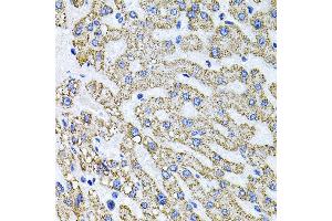 Immunohistochemistry of paraffin-embedded human liver damage using SDC2 antibody (ABIN3022587, ABIN3022588, ABIN3022589 and ABIN6218928) at dilution of 1:100 (40x lens). (Syndecan 2 anticorps  (AA 19-144))