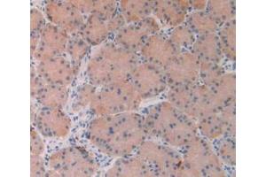 IHC-P analysis of Human Stomach Cancer Tissue, with DAB staining. (FGF19 anticorps  (AA 4-216))
