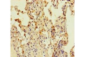 Immunohistochemistry of paraffin-embedded human lung cancer using ABIN7148108 at dilution of 1:100 (C12ORF68 anticorps  (AA 1-194))