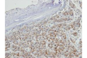 IHC-P Image Immunohistochemical analysis of paraffin-embedded Hep3B xenograft, using PRPS2, antibody at 1:100 dilution. (PRPS2 anticorps)