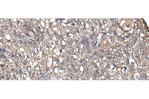 Immunohistochemistry of paraffin-embedded Human lung cancer tissue using KRT73 Polyclonal Antibody at dilution of 1:55(x200) (KRT73 anticorps)