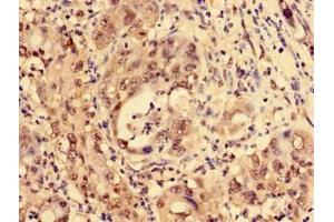 Immunohistochemistry of paraffin-embedded human liver cancer using ABIN7158369 at dilution of 1:100