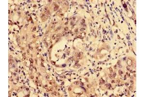 Immunohistochemistry of paraffin-embedded human liver cancer using ABIN7158369 at dilution of 1:100 (LIM Domain Binding 1 Protein anticorps  (AA 50-375))