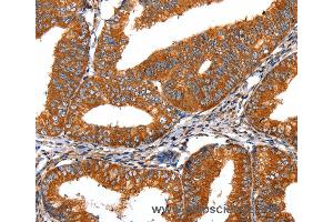 Immunohistochemistry of Human liver cancer using FGFR1 Polyclonal Antibody at dilution of 1:60 (FGFR1 anticorps)