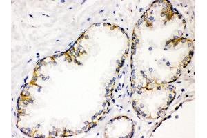 Anti- CD46 Picoband antibody, IHC(P) IHC(P): Human Prostatic Cancer Tissue (CD46 anticorps  (C-Term))