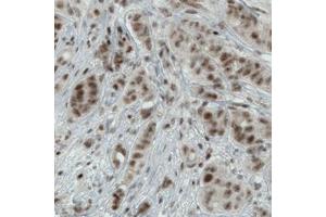 Immunohistochemical staining (Formalin-fixed paraffin-embedded sections) of human breast cancer with WHSC1 monoclonal antibody, clone CL1057  shows moderate nuclear immunoreactivity in tumor cells. (WHSC1 anticorps)
