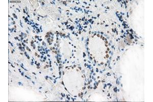 Immunohistochemical staining of paraffin-embedded Adenocarcinoma of colon tissue using anti-XRCC4mouse monoclonal antibody. (XRCC4 anticorps)
