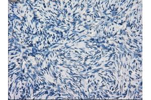 Immunohistochemical staining of paraffin-embedded Adenocarcinoma of breast tissue using anti-KDM4C mouse monoclonal antibody. (KDM4C anticorps)