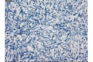 Immunohistochemical staining of paraffin-embedded Adenocarcinoma of breast tissue using anti-KDM4C mouse monoclonal antibody. (KDM4C anticorps)