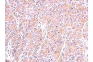 IHC-P Image Immunohistochemical analysis of paraffin-embedded AGS xenograft, using beta Tubulin, antibody at 1:500 dilution.