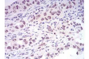 Immunohistochemical analysis of paraffin-embedded endometrial cancer tissues using KDM1A mouse mAb with DAB staining.