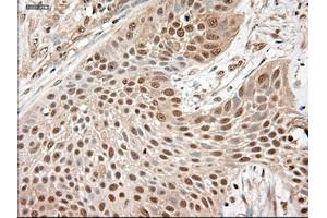 Immunohistochemical staining of paraffin-embedded Adenocarcinoma of breast using anti-NTF3 (ABIN2452548) mouse monoclonal antibody. (Neurotrophin 3 anticorps  (AA 139-257))