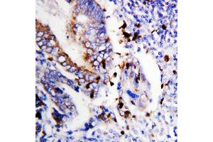 Anti-Bcl-XS antibody, IHC(P) IHC(P): Human Colon Cancer Tissue (BCL2L1 anticorps  (Middle Region))