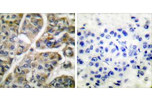 Peptide - +Immunohistochemical analysis of paraffin-embedded human breast carcinoma tissue using Granzyme B antibody (#C0215). (GZMB anticorps)